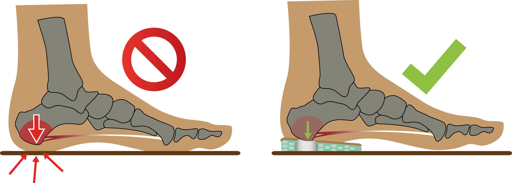 Fußgut Fersenspornhilfe »2 Paar Kissen, entlastet den Fersensporn bei Druck oder Belastung« Packung, 4 Stk. tlg. gepolsterte Vertiefung an der Unterseite entlastet, Hirschleder