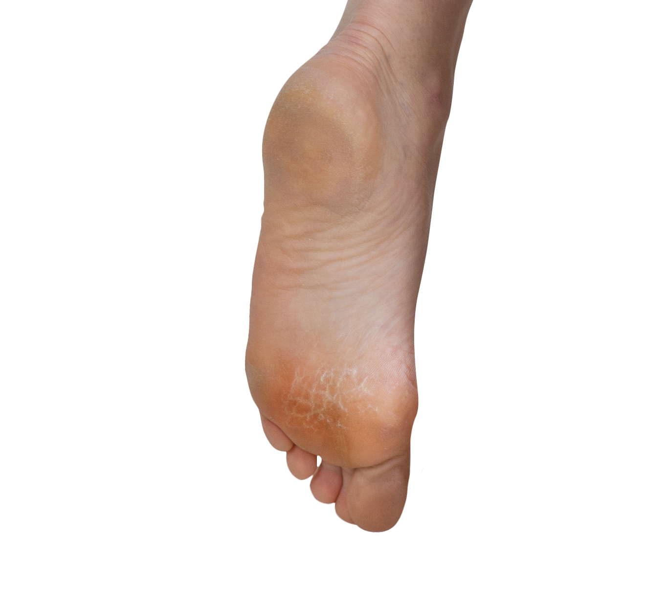 Fußgut Fussballenpolster »Vorfuß Ballenpolster Supersoft« Optimale Druckverteilung, Vorfußpolster, schützt vor Reibung und Druck