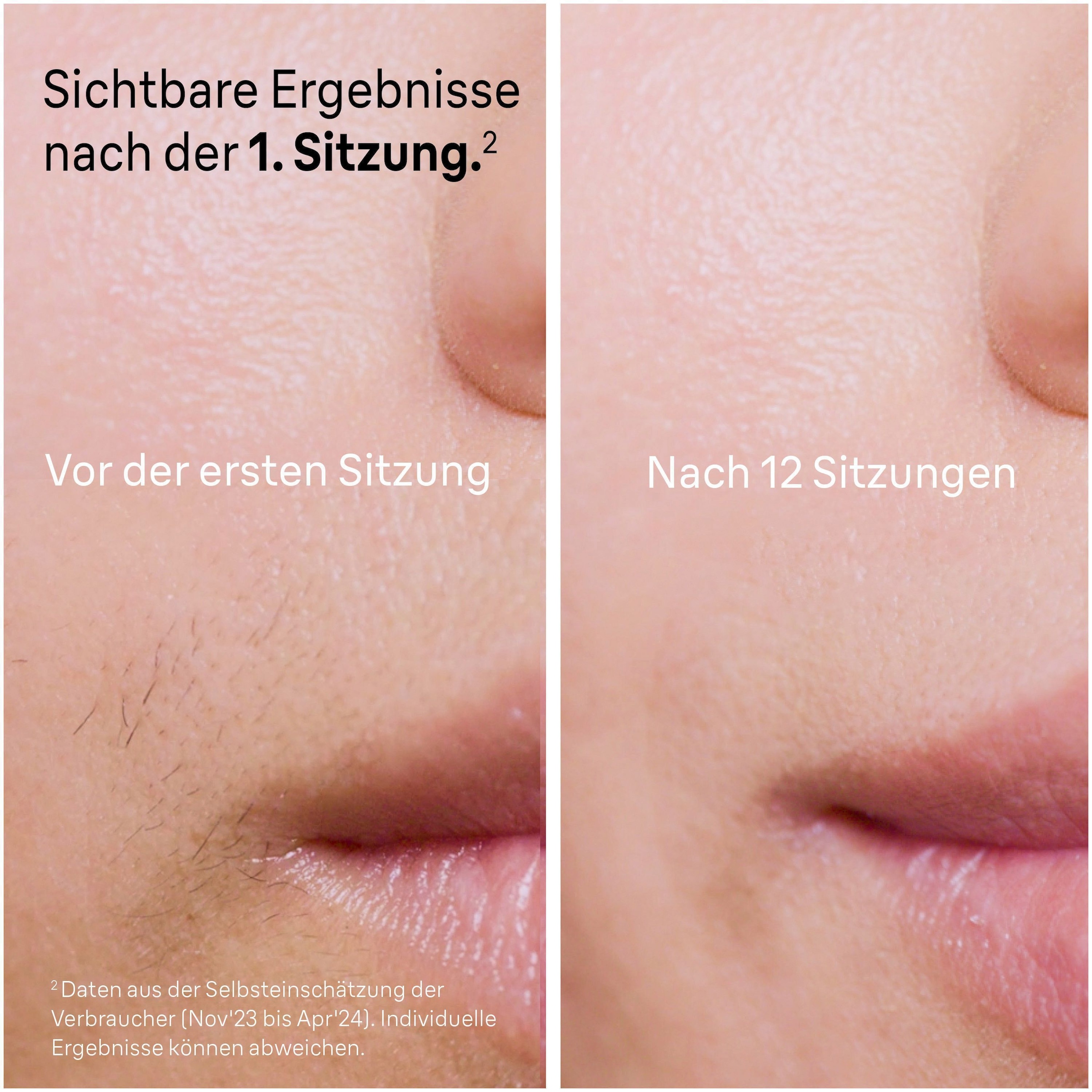 Braun IPL-Haarentferner »Smart Skin i·expert PL7387« 4 Aufsätze für Gesicht & Körper, Venus Rasierer & Aufbewahrungsbox