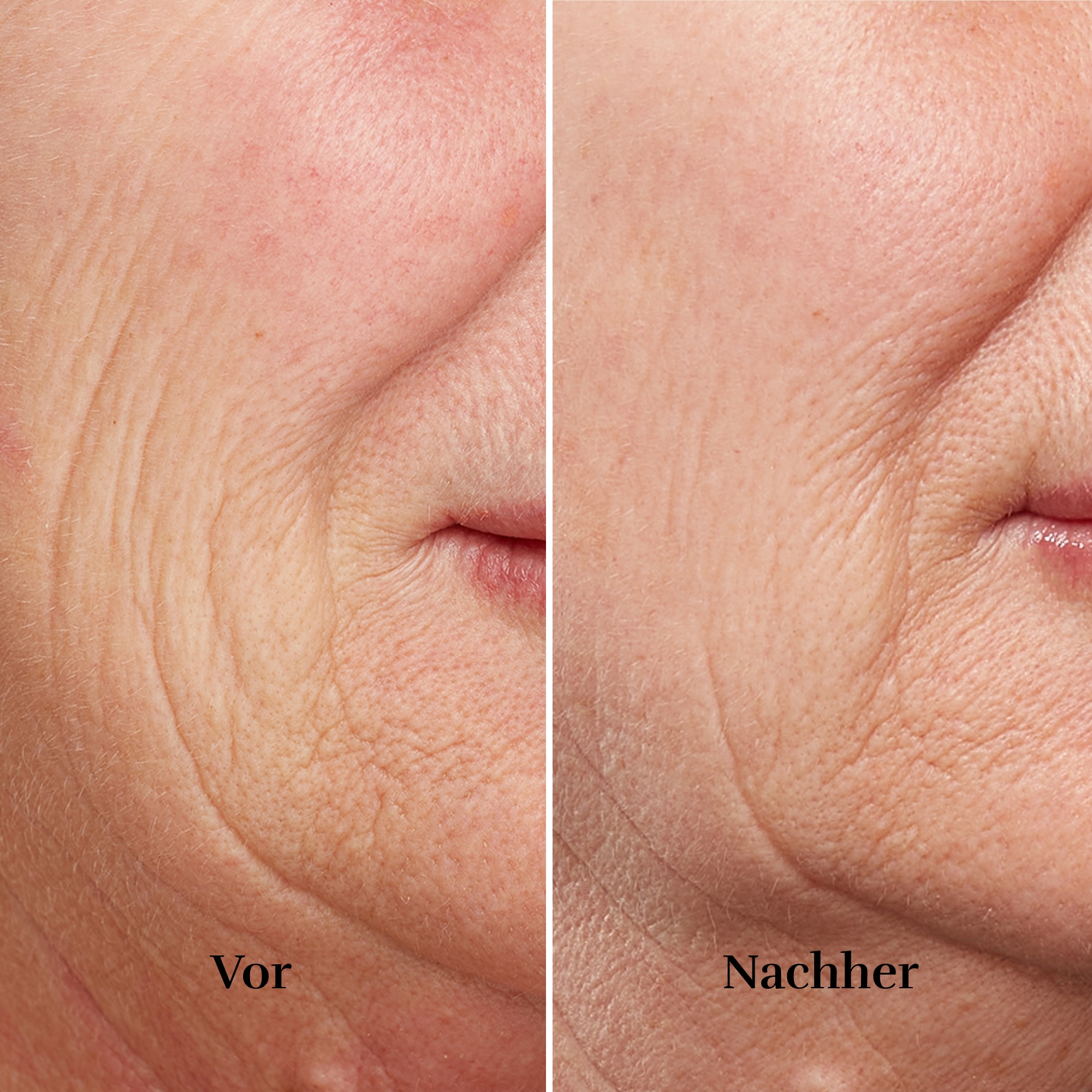 Silk'n Anti-Aging-Gerät »FaceTite Revive«