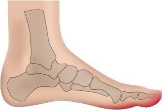Fußgut Überbeinschutz »Hallux Schutz mit Gelpolster«, Druckentlastung bei Hallux Valgus, Hallux Valgus Bandage