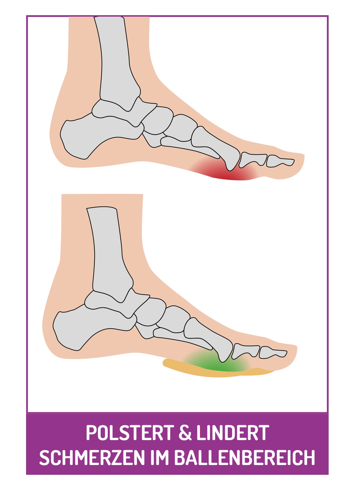 Fußgut Fussballenpolster »Vorfuß Ballenpolster Supersoft« Optimale Druckverteilung, Vorfußpolster, schützt vor Reibung und Druck