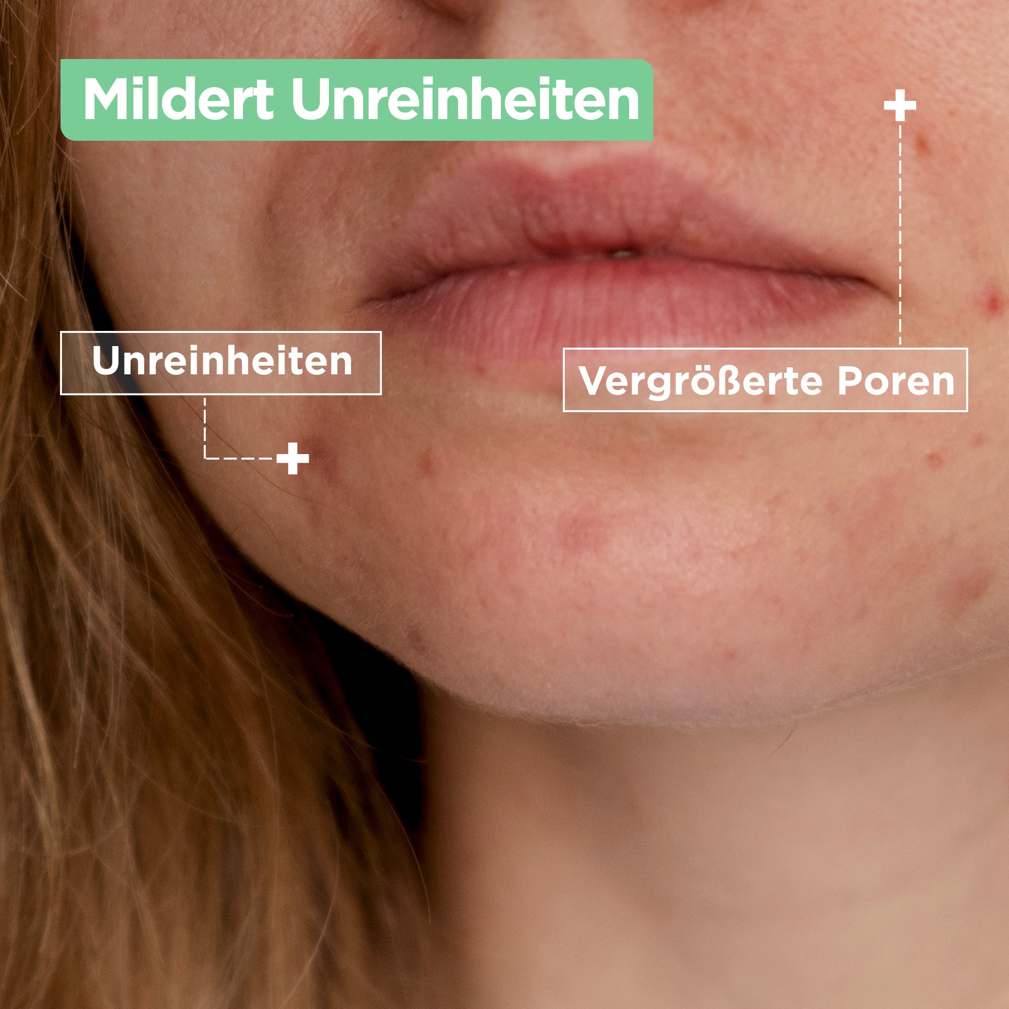 Mixa Gesichtspflege »Mixa Anti-Unreinheiten Gel-Creme« für ölige Haut, sorgt für ein mattes Hautbild, mildert Pickelmale