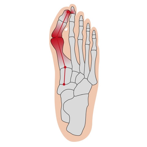 Fußgut Hallux-Bandage »Softkissen mit Fixierband, verhindert Reiben«, Druckentlastung bei Hühneraugen, Schwielen, Entlastung Hallux Valgus