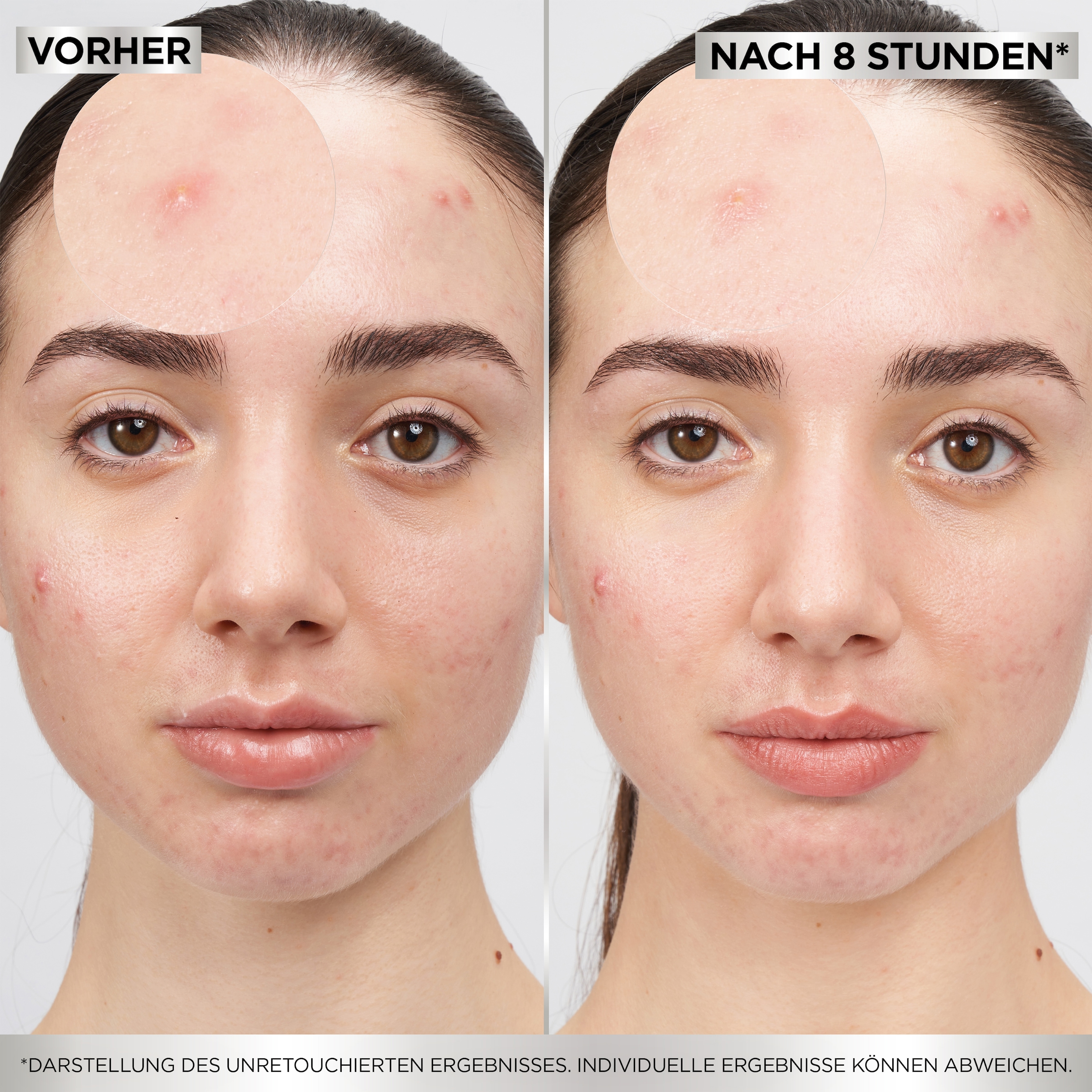 GARNIER Pflegestift »Garnier 8H Invisible Pimple Patch«, Flacht Pickel ab mit Hydrokolloid, keine Pickelmale.