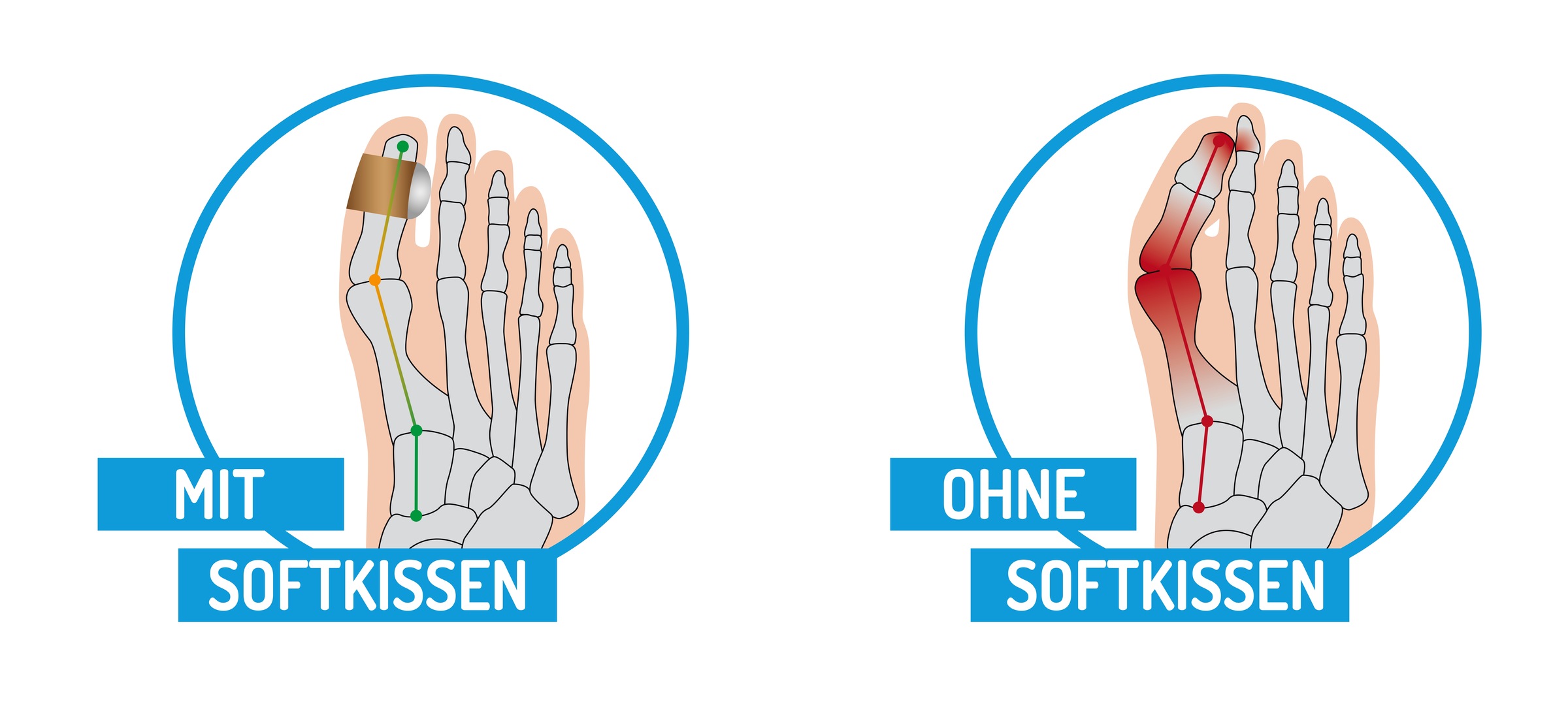 Fußgut Hallux-Bandage »Softkissen mit Fixierband, verhindert Reiben«, Druckentlastung bei Hühneraugen, Schwielen, Entlastung Hallux Valgus