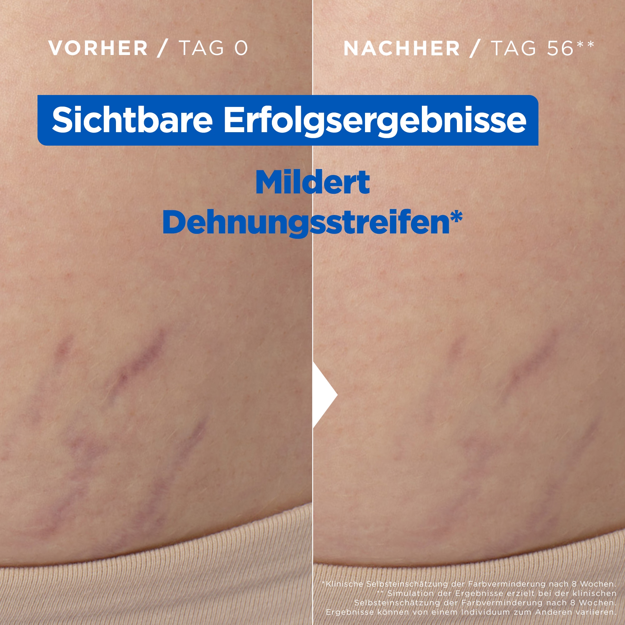 Mixa Körperlotion »Mixa Niacinamide Stretchmark Oil«, Mindert Dehnungsstreifen und deren Juckreiz, für empfindliche Haut.