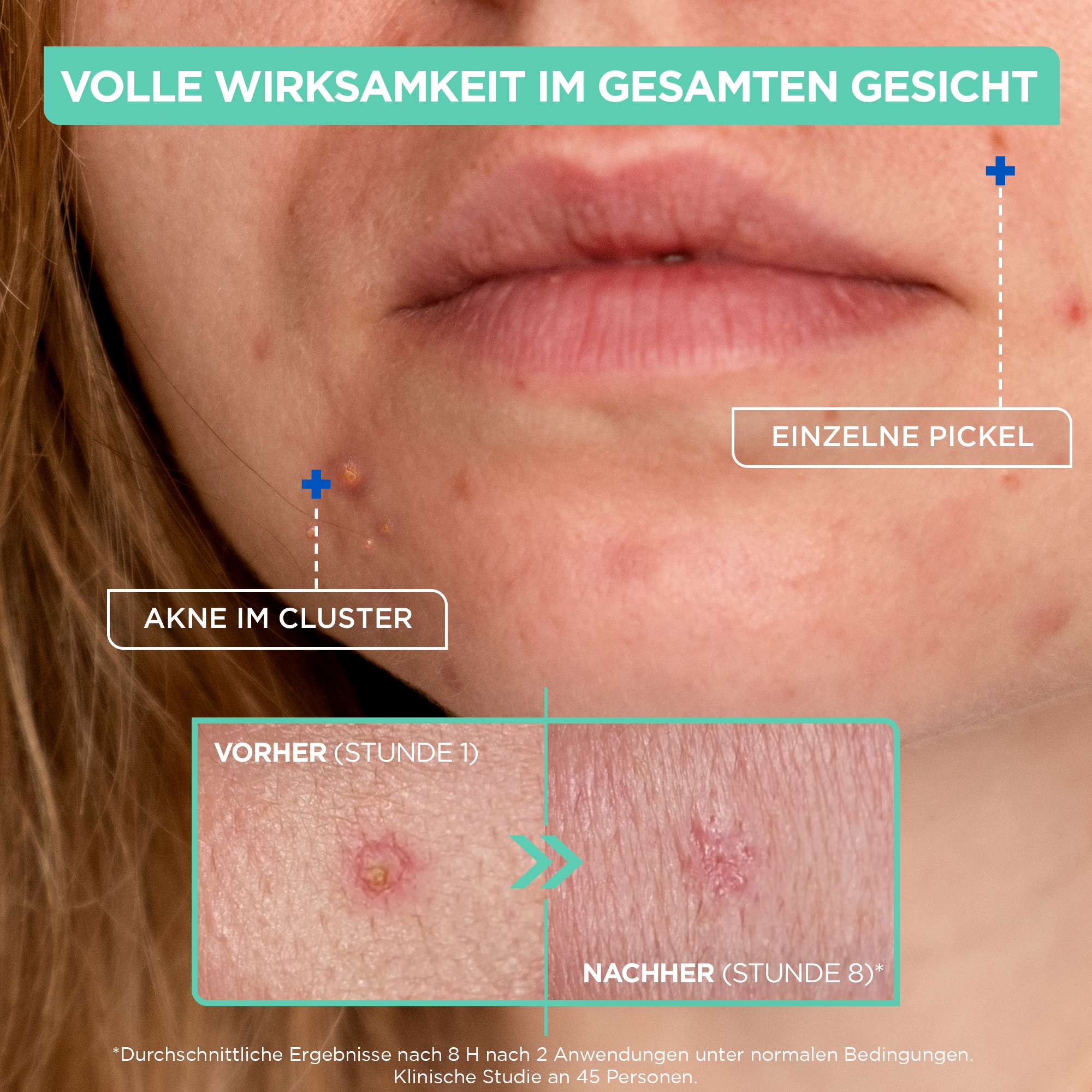Mixa Gesichts-Reinigungscreme »MIXA KONZENTRIERTE ANTI-PICKEL PASTE« mit Niacinamid