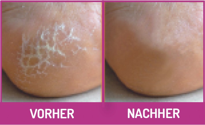 Fußgut Hornhautbalsam »Hornhaut-Reduzier-Balsam, für Diabetiker geeignet, pflegt Ellenbogen«, bis zu 75% Hornhautreduzierung innerhalb von 28 Tagen